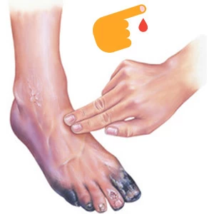 chernejut nogi i palcy na nogah pri saharnom diabete prichiny lechenie i profilaktika