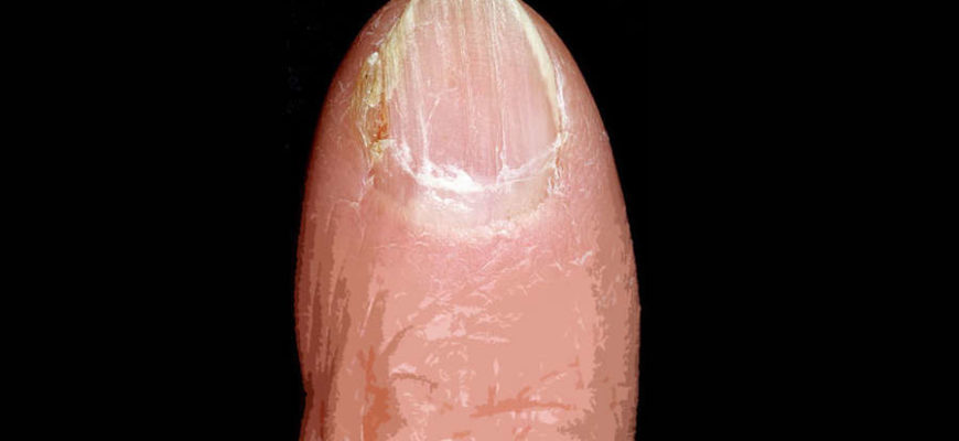onihodistrofiya prichiny vidy podhod k lecheniju
