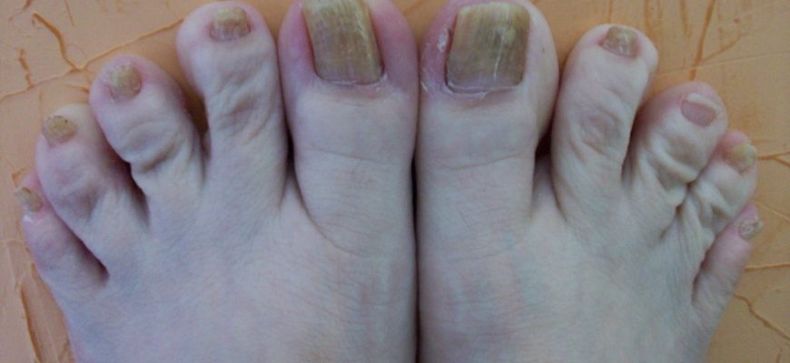 zheltye nogti vyzvannye gribkom toenail